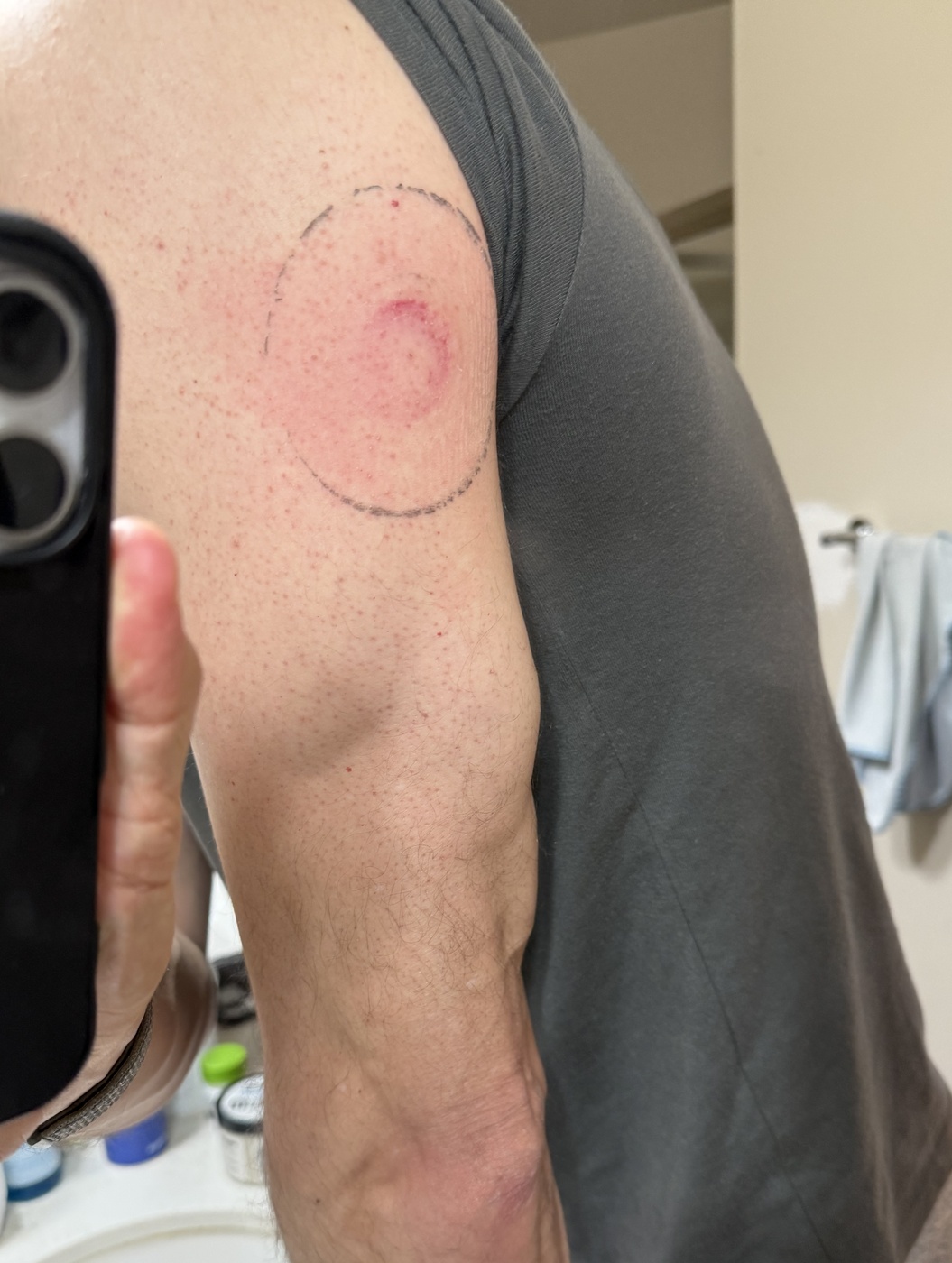 Skin irritation after removing the glucose monitor